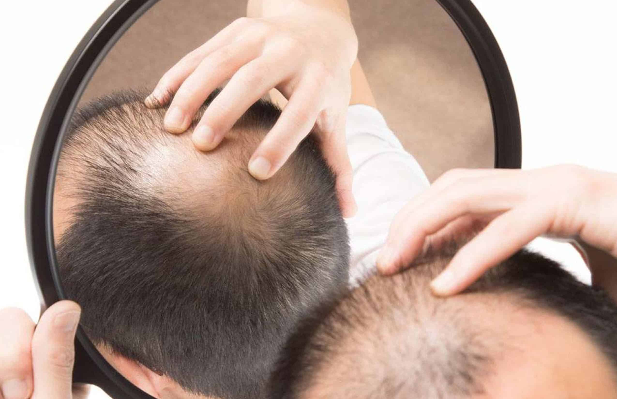 Androgenetic Alopecia in Chihuahua