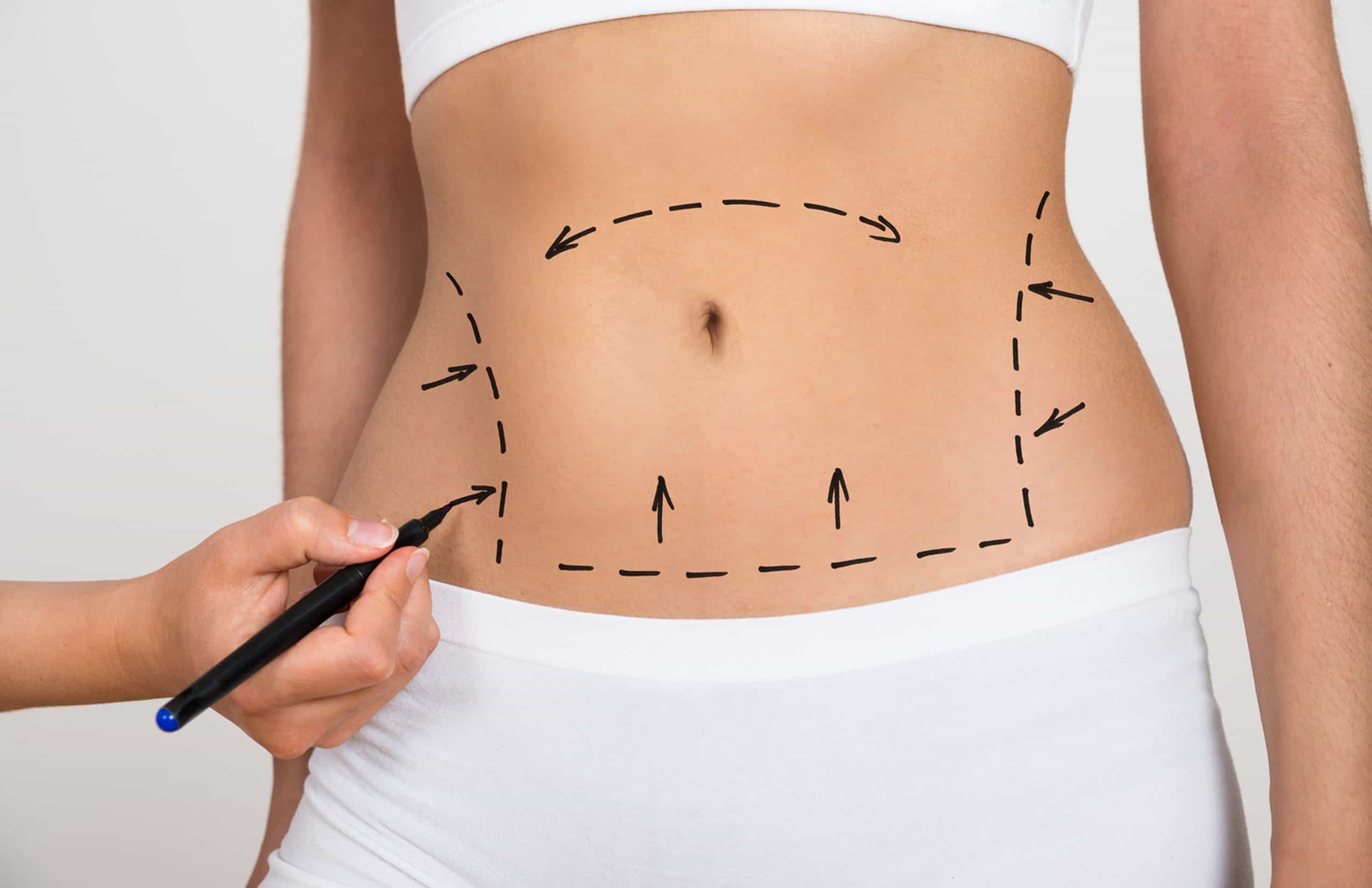 Liposuction / Body Contouring in Chihuahua