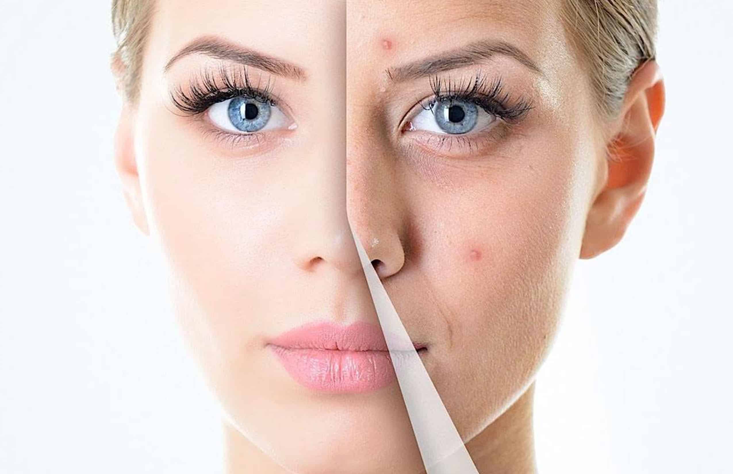 Peeling en Chihuahua con el Dr. José Antonio Silva