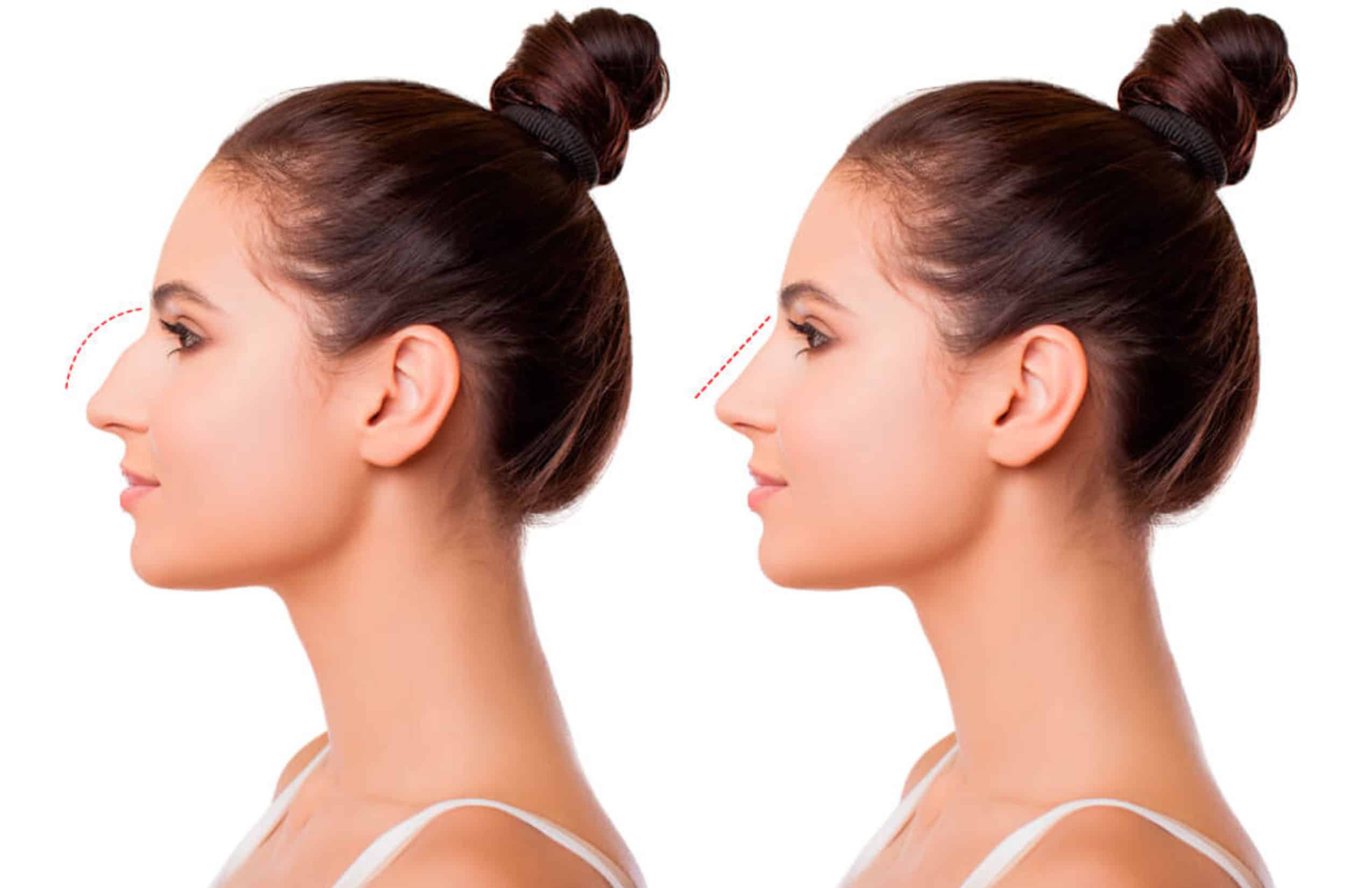 Rhinoplasty in Chihuahua with Dr. José Antonio Silva